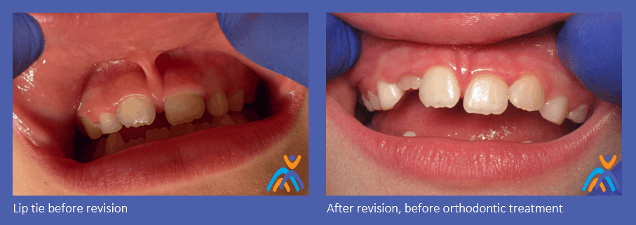 Lip Tie in Babies: Effects, Correction, Feeding Help